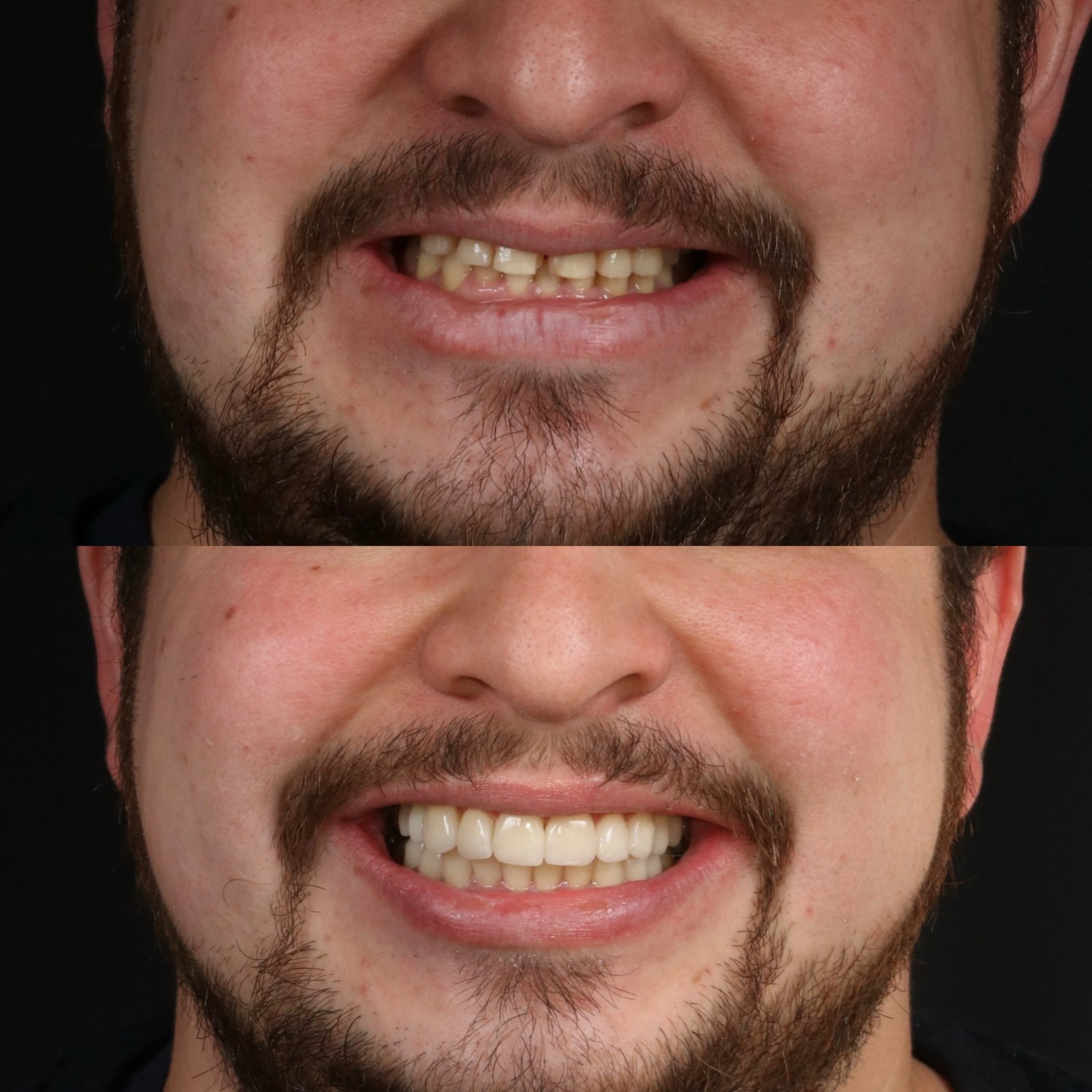 Carillas dentales - Caso 6